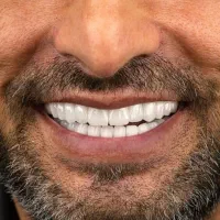 تخفیف ایمپلنت   شرایط ویژه دندانپزشکی|خدمات آرایشگری و زیبایی|اسکو, |دیوار