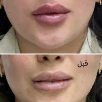 تزریق فیلر و بوتاکس در کلینیک پوست و لیزر سهرابی|خدمات آرایشگری و زیبایی|کرمانشاه, |دیوار