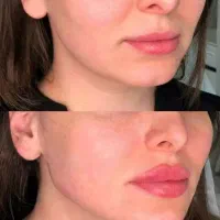 تخفیفات ۵۰% دکتر بوتاکس مزو فیلر ژل لب روسی|خدمات آرایشگری و زیبایی|مشهد, هنرستان|دیوار