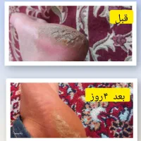 ترک پا،میخچه، اگزما|آرایشی، بهداشتی، درمانی|قروه, |دیوار