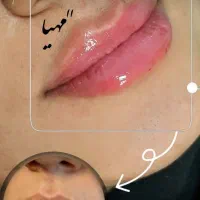 فیلر و بوتاکس وانزیم فیلر|خدمات آرایشگری و زیبایی|قم, دروازه چوبی|دیوار