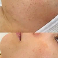 فیشیال تخصصی و درمانی پوست|خدمات آرایشگری و زیبایی|آمل, |دیوار