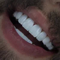 ایمپلنت،لمینت، کامپوزیت دوفک ۱۰میلیون اقساطی