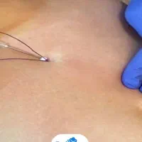 متد جدید لاغری با نخ های قابل جذب در مطب دکتر|خدمات آرایشگری و زیبایی|پاکدشت, پاکدشت (مامازند)|دیوار