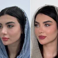 ژل بوتاکس خالبرداری فشیال زگیل تناسلی مطب زیبایی|خدمات آرایشگری و زیبایی|تبریز, |دیوار