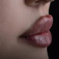 تزریق ژل و بوتاکس در منزل،لیزر و دستگاه لاغری