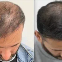 از کچلی خسته شدی بیا من راهکارشو دارم