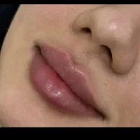 تزریق ژل و بوتاکس با نازلترین قیمت