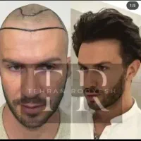 جشنواره کاشت مو یک روزه فول تراکم