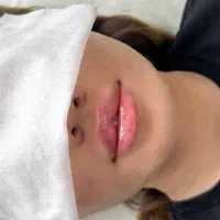 خدمات ژل و فیلر به صورت تخصصی