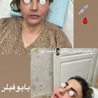جشنواره ویژه توسط پزشک،پی آرپی،بایوفیلر،فیلر