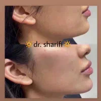 جشنواره ۵۰ درصدی ژل و بوتاکس توسط جناب دکتر شریفی|خدمات آرایشگری و زیبایی|قم, بلوار امین و ساحلی|دیوار