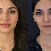 آموزش فیلر و بوتاکس و prp‌ وچال گونه مطب پزشک