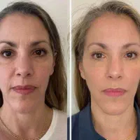 مدل بوتاکس و مزوبوتاکس ویژه بانوان و آقایان