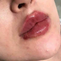 تزریق ژل و بوتاکس و کاشت نخ و مزوژل های جوان ساز|خدمات آرایشگری و زیبایی|شیراز, ابیوردی|دیوار