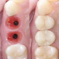 دندانپزشکی،ایمپلنت،اوردنچر با اقساط دو ساله|خدمات آرایشگری و زیبایی|اهر, |دیوار