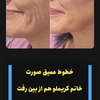کرم بوتاکس صورت|آرایشی، بهداشتی، درمانی|اهواز, کیان اباد|دیوار