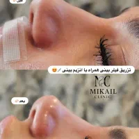 انجام خدمات رایگان،فیلر،بوتاکس،نخ،مزونیدلینگ