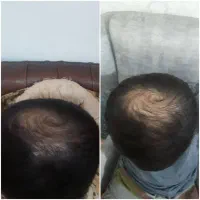 درمان قطعی ریزش