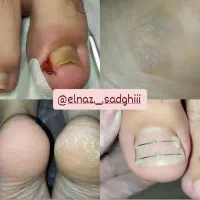 درمان غیر تهاجمی ناخن فرورفته و زگیل و میخچه ..