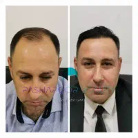 کاشت مو تخصصی|خدمات آرایشگری و زیبایی|پارس‌آباد, |دیوار