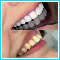 دندانپزشکی/کامپوزیت دریک جلسه/ترمیم/عصبکشی|خدمات زیبایی و سلامت|تهران, تهرانپارس شرقی|دیوار