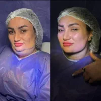 ساکشن غبغب به روش وی لاین