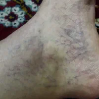 حجامت / زالو درمانی/ بادکش پرستار آقاوخانم باسابقه|خدمات آرایشگری و زیبایی|مشهد, امام خمینی|دیوار