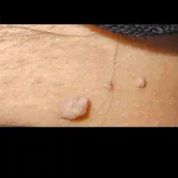 درمان خال گوشتی|آرایشی، بهداشتی، درمانی|کوهدشت, |دیوار