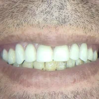 دندان مصنوعی لمینتی طرح لبخند|خدمات آرایشگری و زیبایی|محمدیه-قزوین, |دیوار