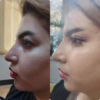 لیفت شقیقه وگونه با جراحی