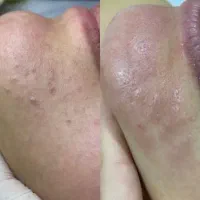 تخفیف ویژه پاکسازی پوست|خدمات آرایشگری و زیبایی|فولادشهر, C4|دیوار