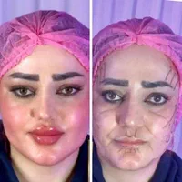 جشنواره باور نکردنی ویژه. ژل و بوتاکس.فیلر مزو ژل
