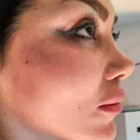 تزریق فیلر بوتاکس ساکشن چربی وتزریق چربی|خدمات آرایشگری و زیبایی|کرمانشاه, |دیوار