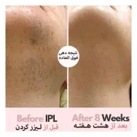 لیزر خانگی موهای زائد صورت و بدن/تخفیف بلک فرایدی|آرایشی، بهداشتی، درمانی|قم, زنبیل آباد|دیوار
