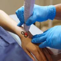 پاک کردن انواع تتو صورت و بدن و درمان لک پیری