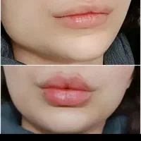 تخفیف فیلر و بوتاکس با جدیدترین متد