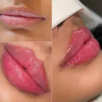 لیزر ژل بوتاکس هایفو مزو پی آر پی خال برداری