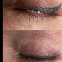 حذف تتو ابرو، خط چشم در یک الی دو جلسه به کمک لیزر