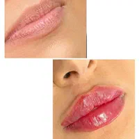 تزریق ژل بوتاکس مادلینگ و ساکشن غبغب|خدمات آرایشگری و زیبایی|تهران, آسمان|دیوار