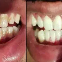 جرم گیری دندان تقریبا رایگان|خدمات آرایشگری و زیبایی|بیرجند, |دیوار