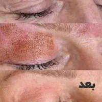 کک و مک،پلاسما،خالبرداری،جوانسازی