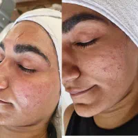 فیشال تخصصی ،پاکسازی پوست|خدمات آرایشگری و زیبایی|اصفهان, چشمه باقرخان|دیوار