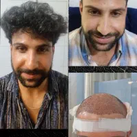 کاشت مو،ابرو،ریش با ضمانت نامه کتبی|خدمات زیبایی و سلامت|تهران, گاندی|دیوار