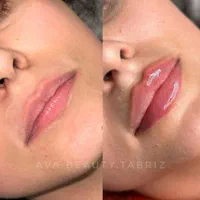 تزریق تخصصی فیلرلب بدون درد و باتضمین|خدمات آرایشگری و زیبایی|تبریز, |دیوار
