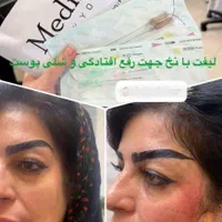 فیلر لب زیر چشم فیلر بادی نخ لیفت پی ار پی مزو|خدمات آرایشگری و زیبایی|اصفهان, سیچان|دیوار