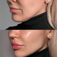 بوتاکس و فیلر پی ار پی لیفت نخ مزوتراپی کانتورینگ