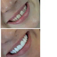 کامپوزیت ونیر آلمانی|خدمات آرایشگری و زیبایی|تهران, چیذر|دیوار