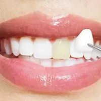 مدل برای انجام لمینت دندان|خدمات آرایشگری و زیبایی|تهران, فرمانیه|دیوار