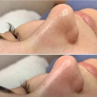 فیشیال پاکسازی|خدمات آرایشگری و زیبایی|چغادک, |دیوار